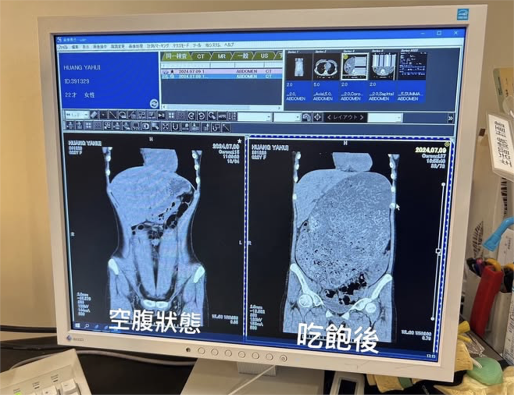 食物到底去哪？大胃王小慧照CT「巨大黑洞現形」 女神嚇傻：魯夫的胃
