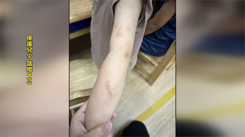 停托保母涉虐待！　孩子身上多處咬痕.瘀傷　母控保母虐待