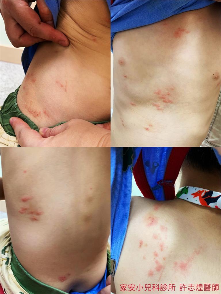 男童全身「紅疹+癢爆」！醫掀衣驚見「8腳蟲吸血」：會從冷氣孔入侵
