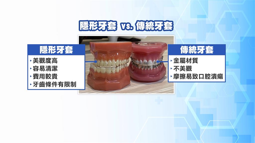 隱形牙套蔚為風潮 業者找名人拍片分享 帶動百億商機