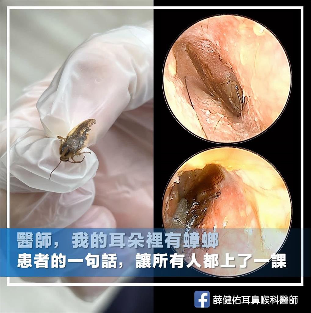 他喊「耳內有1可怕生物」家人不肯信！醫夾出「完整1大隻」診間瞬間沉默