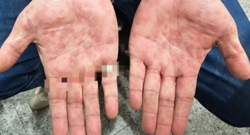 男子露營手掌出現紅斑「以為被蟲咬」 一問AI竟確診「二期梅毒」!