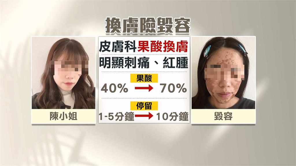 換膚變毀容！美容師疑誤拿高濃度果酸　女臉部大面積灼傷