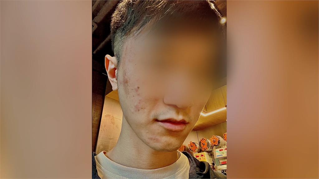 「鮮蝦腸粉」吃到一半遭店家撤掉 男子臉上大面積過敏