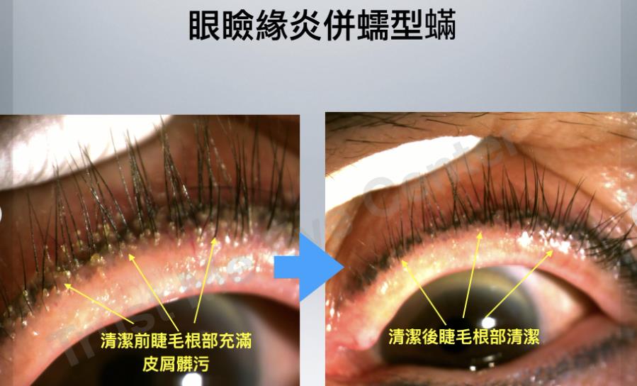 年輕女生眼睛乾、癢到睡不著!醫揪元兇 竟是「它」寄生在眼瞼毛囊中
