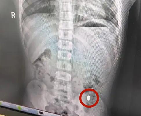 11歲男童稱練舌力誤吞「10克金豆」 媽氣炸:不准在外面上廁所!