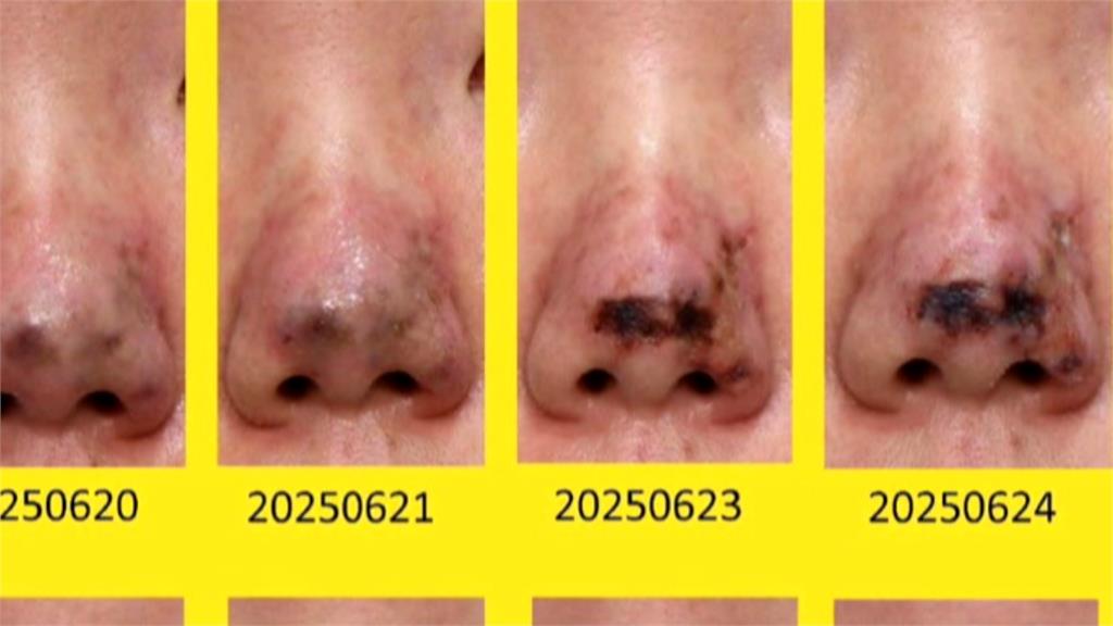 海外醫美熱潮升！　美容醫學會揭黑幕「恐危及生命」