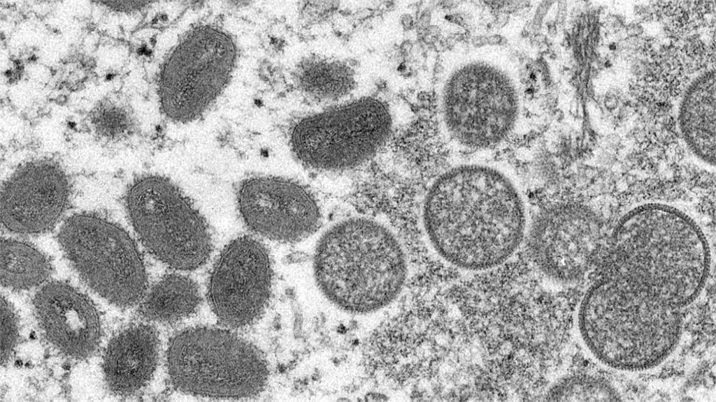 世衛才宣布M痘為「公衛緊急事件」　瑞典與巴基斯坦接連傳病例