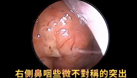 她以為只是長期「慢性鼻竇炎」 醫驚揪「極微小不對稱」竟是鼻咽癌!