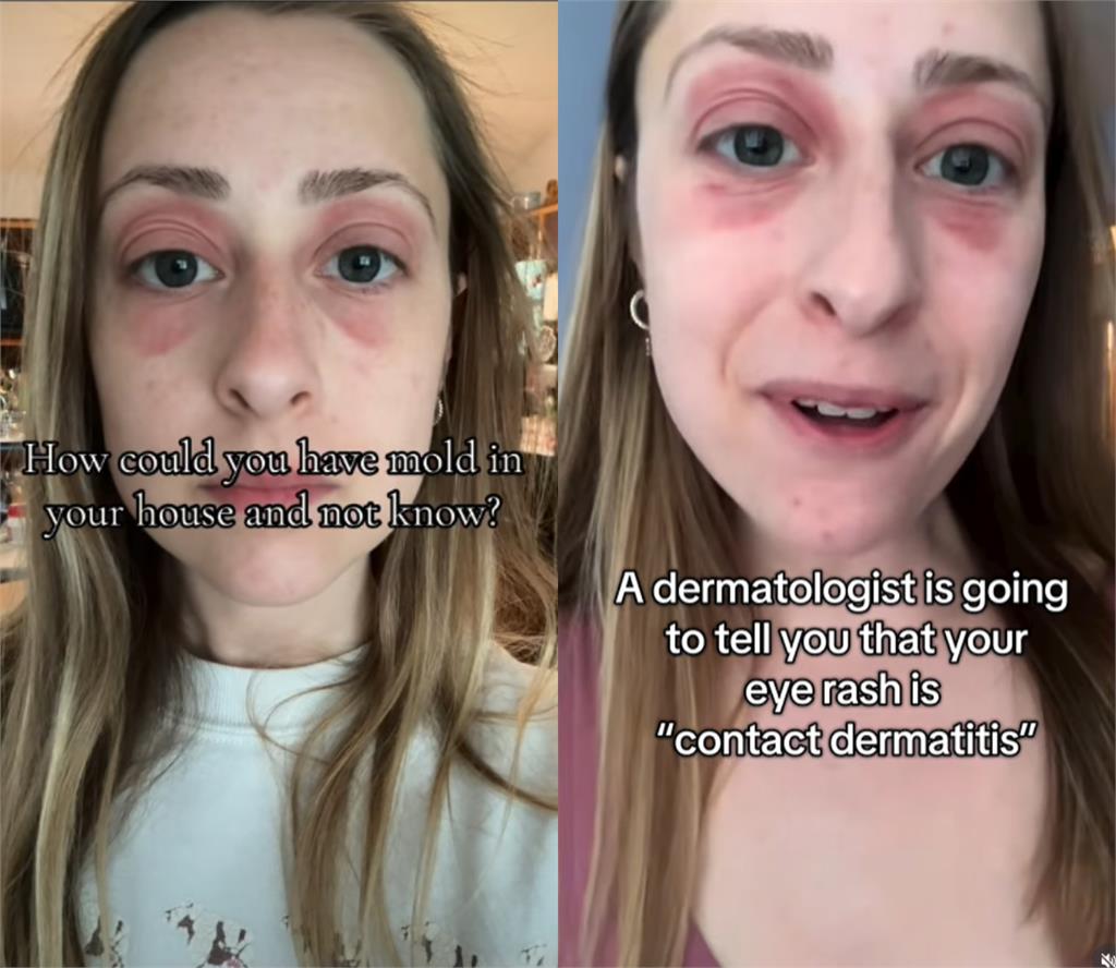 28歲人妻「砸1200萬買房」入住竟毀容！狂長紅疹「眼冒鮮紅」一翻地毯嚇瘋