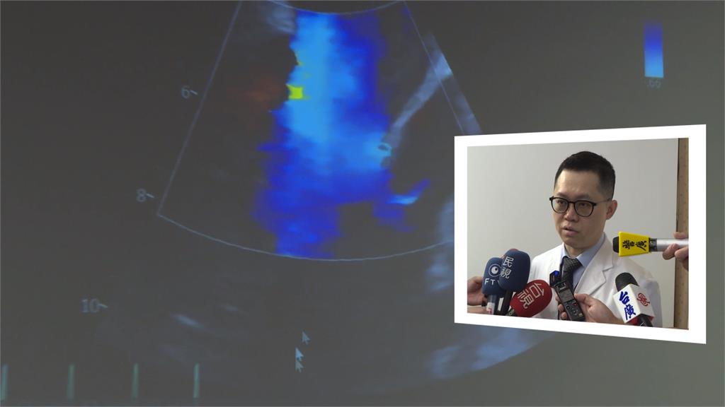 首例!5旬男雙重心臟病威脅 微創手術「免開胸」復原良好