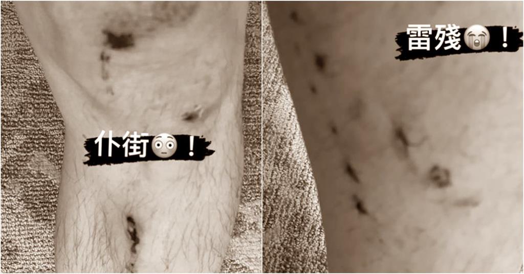 60歲庾澄慶騎車慘摔　全身多處受傷傷勢照曝光！