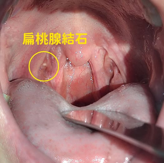 早晚都刷牙喉嚨卻卡「超臭白色顆粒」？醫授「4招」根治千萬別亂摳！