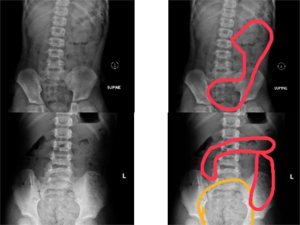 男童唇發紫送急診曝原因!照X光「這1物」塞到胸口