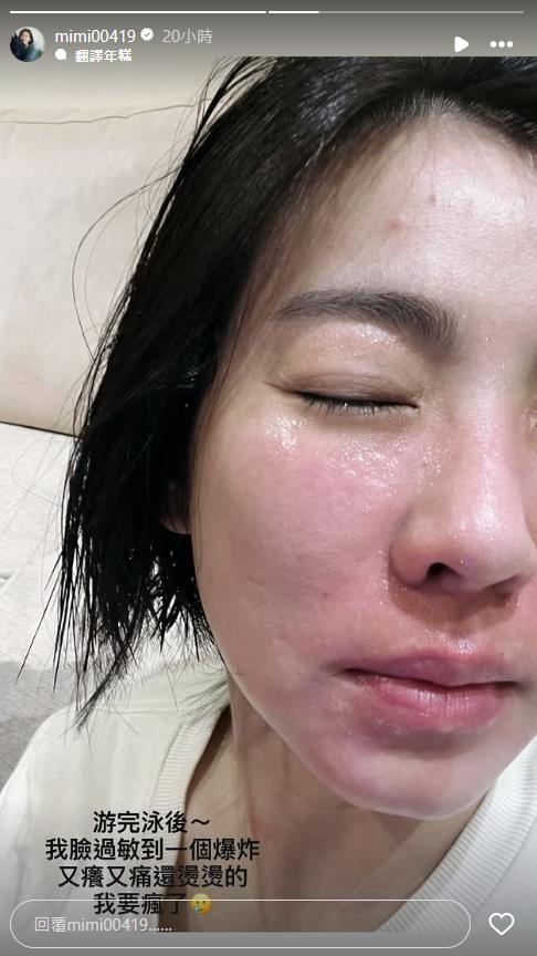 米可白寒流「緊身泳裝」下水出事!「招牌優點」整片紅腫…她曝慘況:我要瘋了