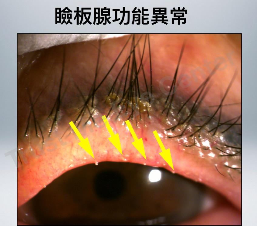 眼睛乾澀、異物感別輕忽!小心「瞼板腺阻塞」 專家教你護眼大作戰