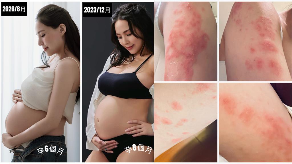 熊熊驚傳得「孕晚期蕁麻疹」！曝光「超慘圖片」粉絲超心疼