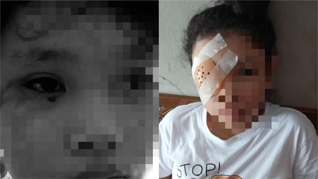 泰國12歲女童疑遠端上課狂盯手機8小時　隔天竟眼睛血管爆裂流血淚