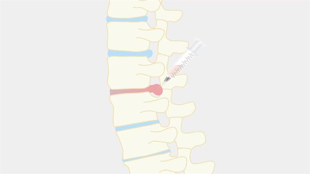 阻止椎間盤退化、顯著改善慢性下背痛　研究自體血療法獲登國際期刊