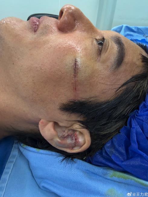王力宏中國開唱「耳骨撞碎」驚悚畫面曝！證實「重摔縫39針」文末預告1事