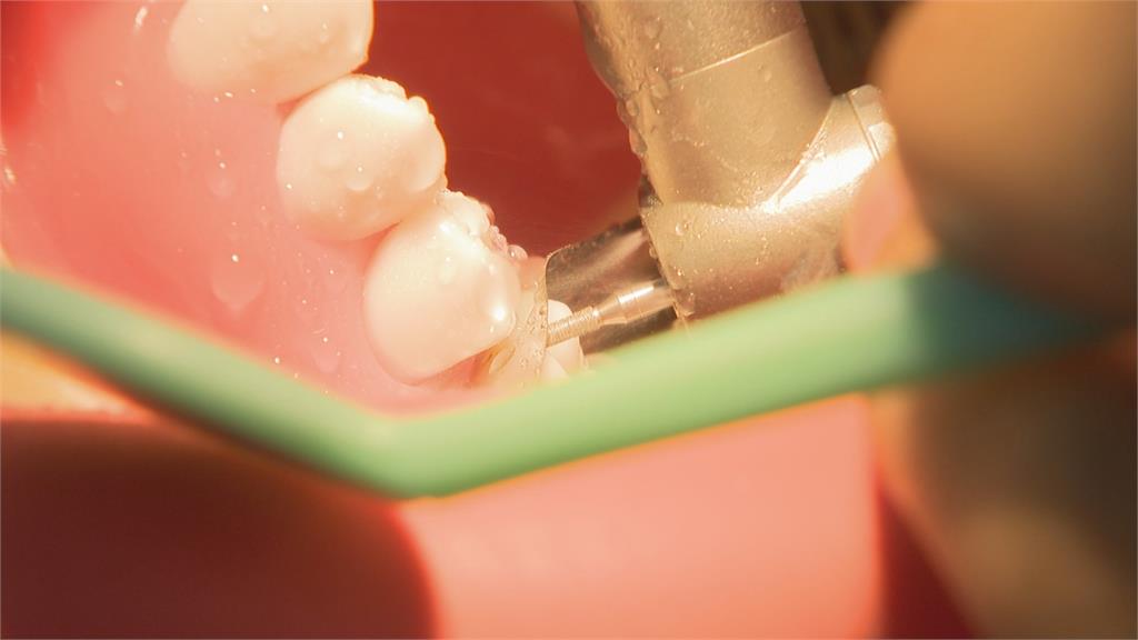 牙齒問題不能拖 與糖尿病、失智風險息息相關 迎戰超高齡化社會 健康從齒開始