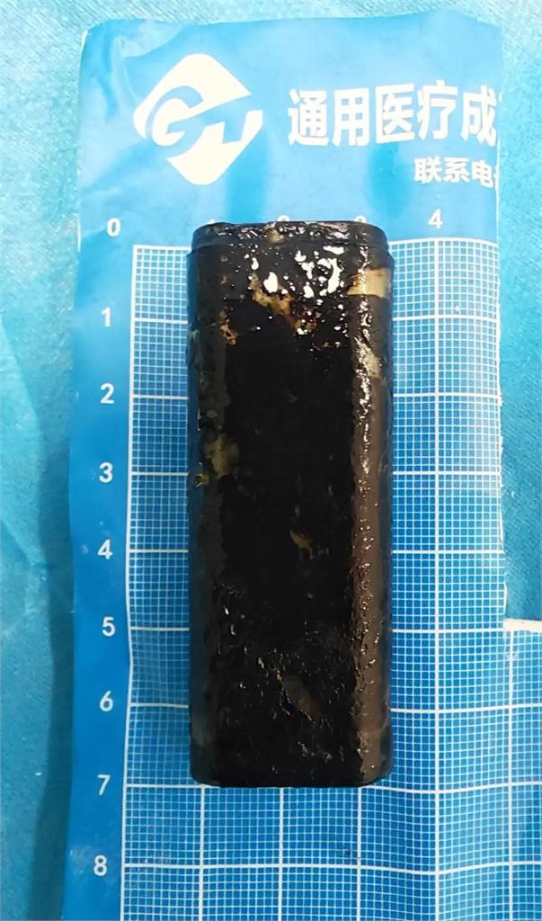 67歲老翁胃裡藏「30年前打火機」肚子爆痛！醫靠「1害羞小物」取出竟還能點火