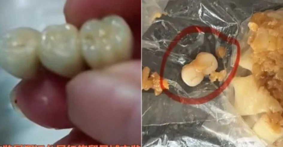 中國女吃香腸驚見「3顆牙齒」!燒賣再爆藏「連體人齒」網嚇瘋:該不會是活摘器官