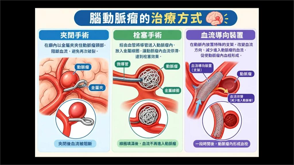 香港旅客劇烈頭痛昏厥　竟是腦動脈破裂　在台緊急手術！
