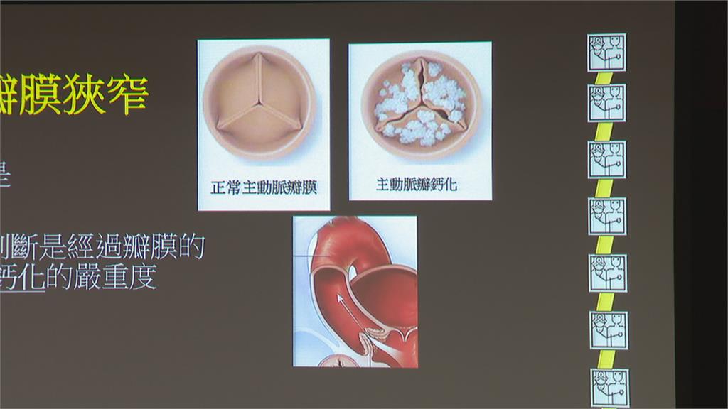 67歲男心臟先天少一瓣膜突昏倒 術後順利出院胖了五公斤