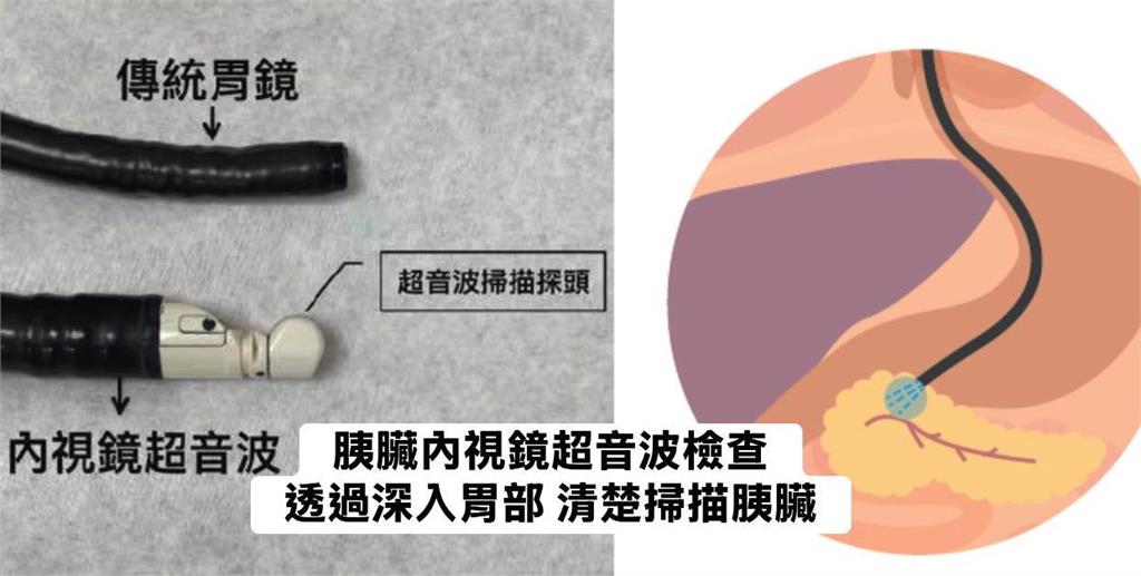 半年瘦10公斤「女腹痛就醫」胃沒問題!醫見2症狀「一照胰臟」已是三期癌