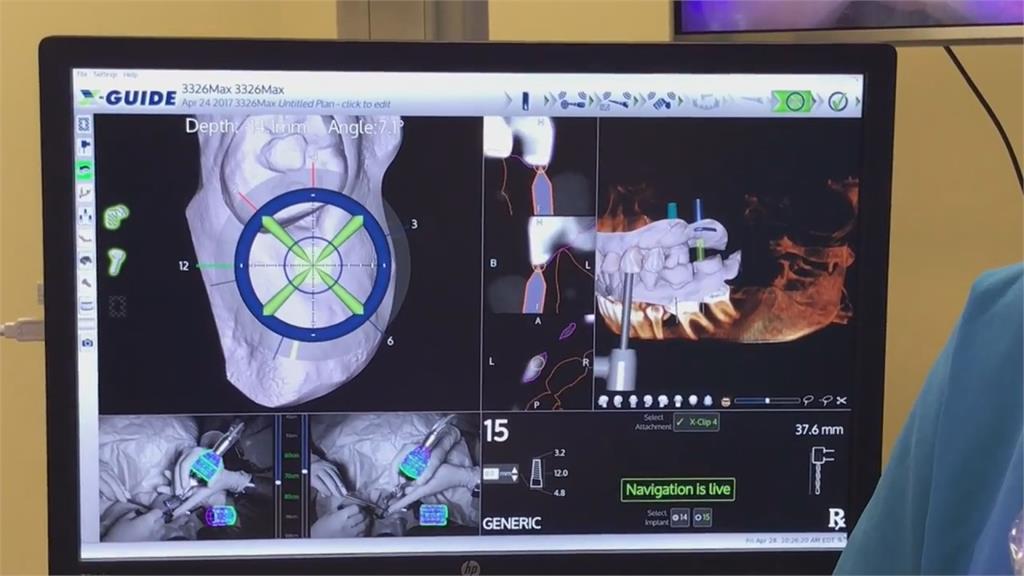 從齒找回笑容 全口植牙怎麼選擇?