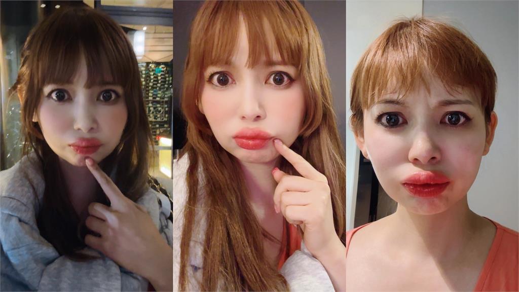 日本宅男女神驚見嘴唇腫脹再惡化恐奪命! 粉絲超心疼:別太勞累
