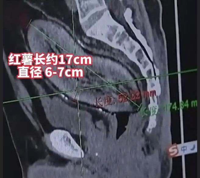 中年阿北後門硬塞「17公分地瓜」卡5小時痛爆!醫傻眼急做「開腹手術」才取出