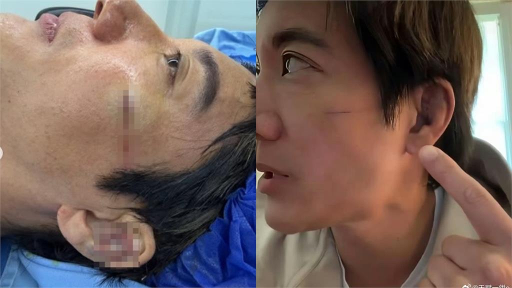 王力宏驚人傷勢曝！好友范瑋琪透露手術過程　大讚：真男人