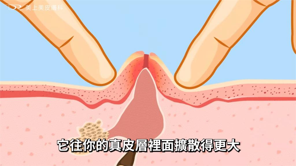 青春痘困擾必看！醫師揭「正確」護理方法　最不鼓勵做1件事