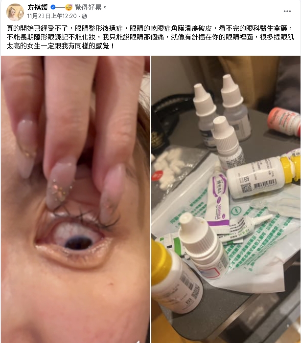 雪碧砸近千萬整形「眼睛留下後遺症」!她崩潰喊「像被針插」慘況曝光