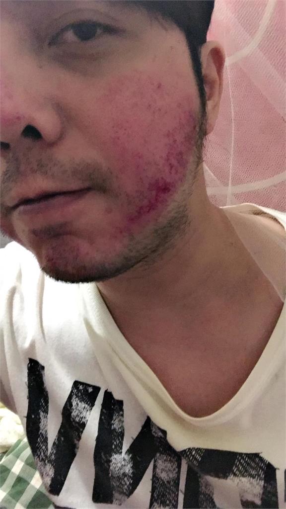 快新聞/聽到大炳被汙衊 小炳與陌生人打架傷勢曝光