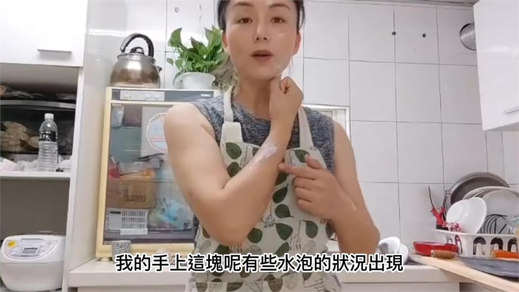 在臺遇蟲害被「毒液攻擊」險(xiǎn)毀容 中國人妻一覺起來俏臉成花貓