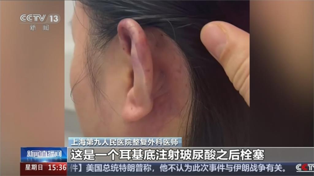 中國瘋整形「精靈耳」 耳朵植入假體恐面部癱瘓