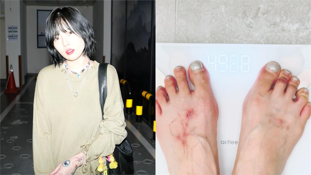 32歲泫雅減肥暴瘦「剩49公斤」!往下看「腳背全是傷」驚悚照片曝光了