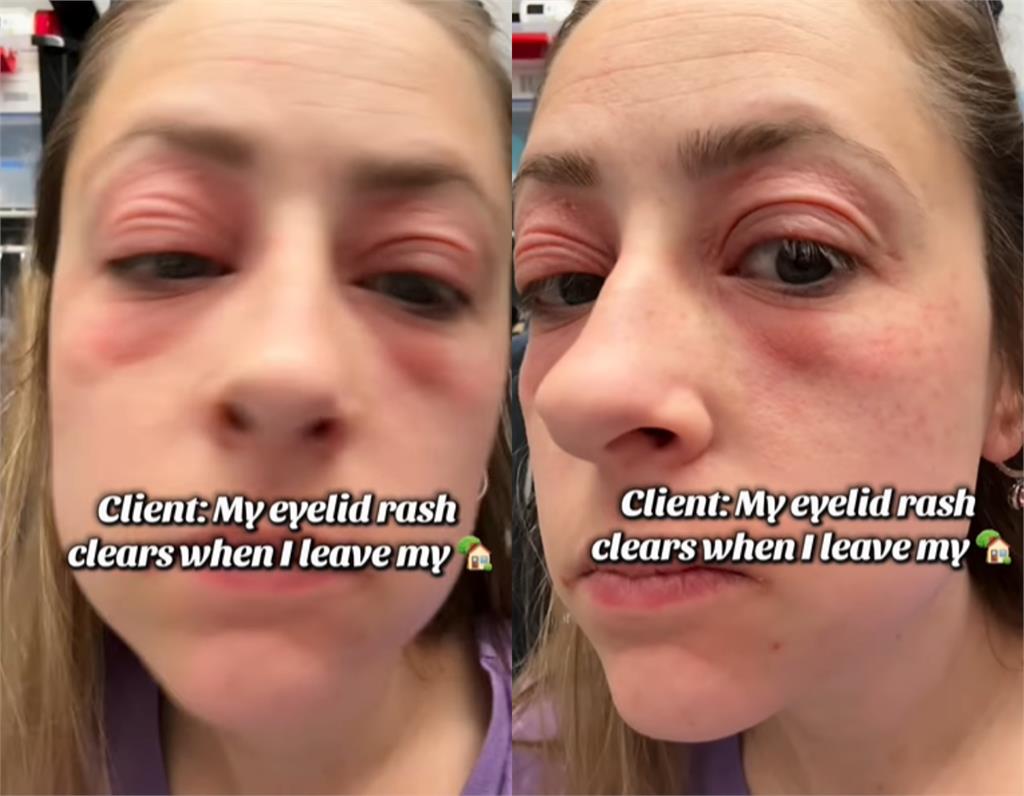 28歲人妻「砸1200萬買房」入住竟毀容！狂長紅疹「眼冒鮮紅」一翻地毯嚇瘋