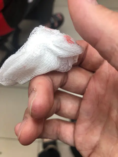 頭髮不慎插進手指!才拖4天…傷口竟化膿「需強行拔出」:痛到快往生