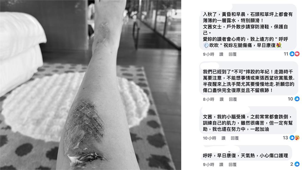 66歲陳文茜散步跌倒 膝蓋挫傷「噴黑血」超嚇人