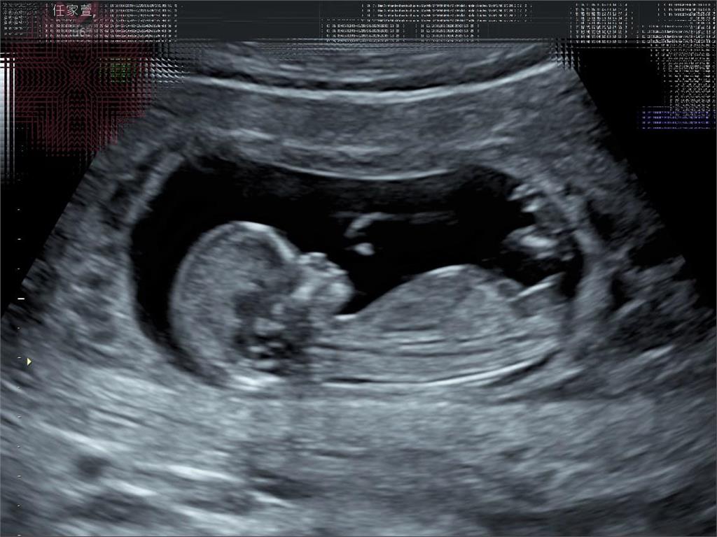 Selina懷孕初期「孕肚大到像6個月」！子宮「有4顆肌瘤」最大4公分