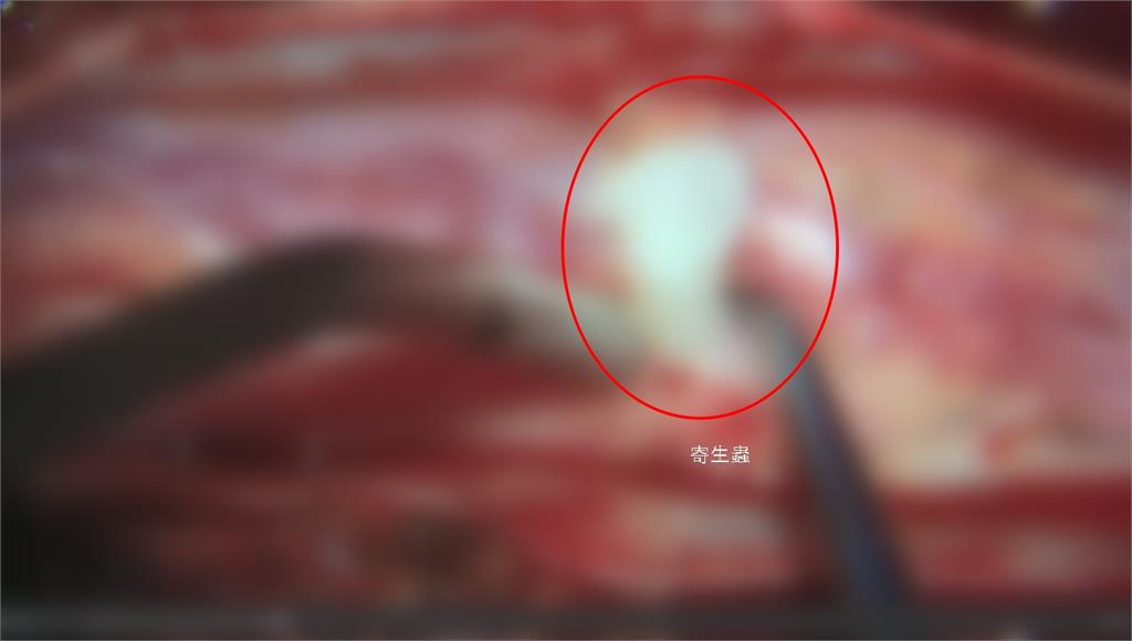 她腰腿痛2年「全身癱瘓」！竟在脊髓挖出「數千條寄生蟲」醫嚇瘋：像撈麵條