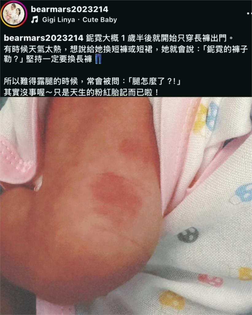愛女堅持出門穿長褲！熊熊曬腿上粉紅胎記　遭問「怎麼了」親揭真相！