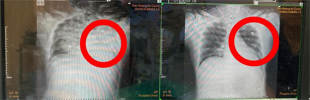 44歲男喝珍奶「嗆咳秒昏迷」送急診!搶救21天奇蹟康復「致命原因」曝光
