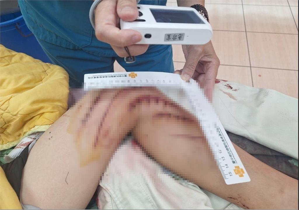破損水溝蓋吃人！　嘉義國一生不慎踩空遭割「送醫縫17針」