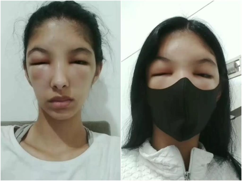 19歲女模染髮後變豬頭！「雙眼腫脹＋頭皮流湯」過敏超嚴重險毀容