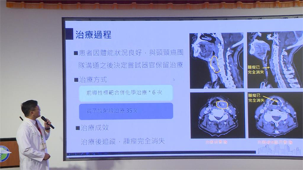 7旬嬤第四期下咽癌　「質子治療」　保住喉嚨